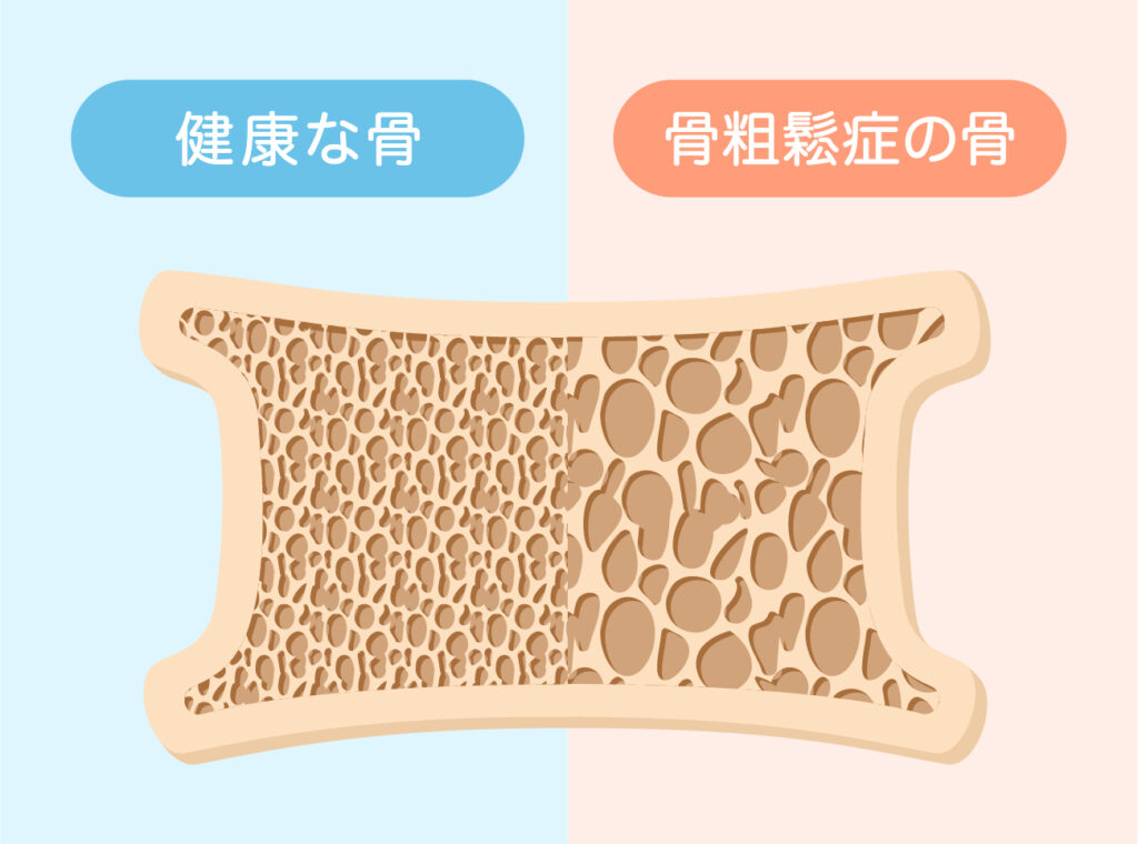 健康な骨と骨粗しょう症の骨の比較