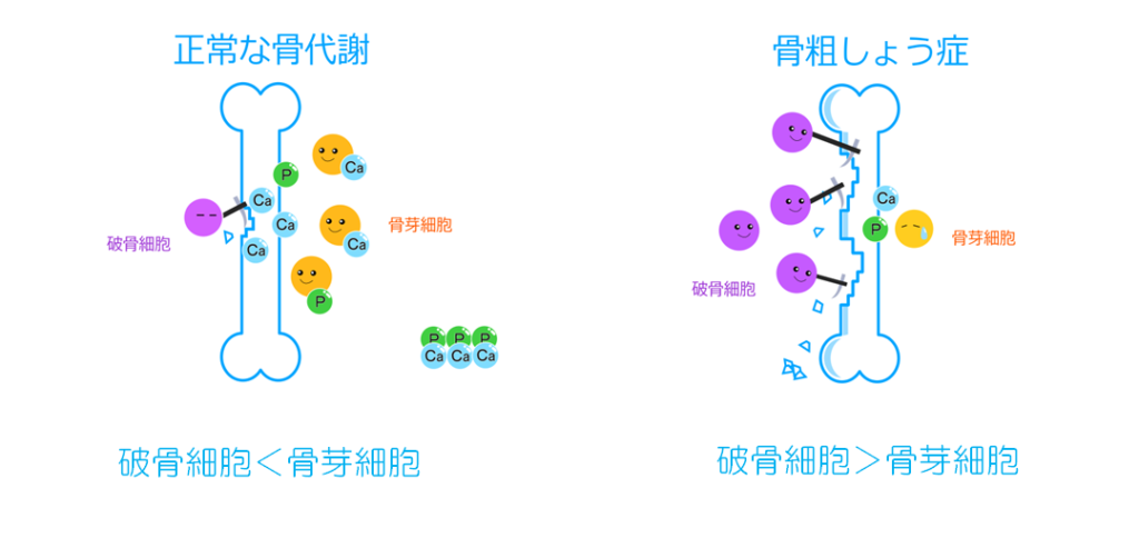 骨粗しょう症の骨代謝